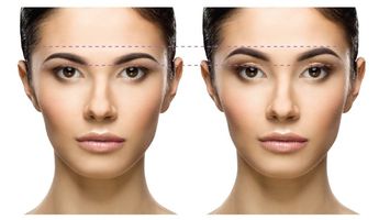 EYEBROW LIFT